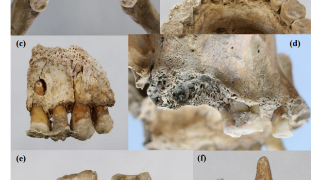 Dentaduras encontradas en la excavación, con la argamasa que parece que les metían en la boca.